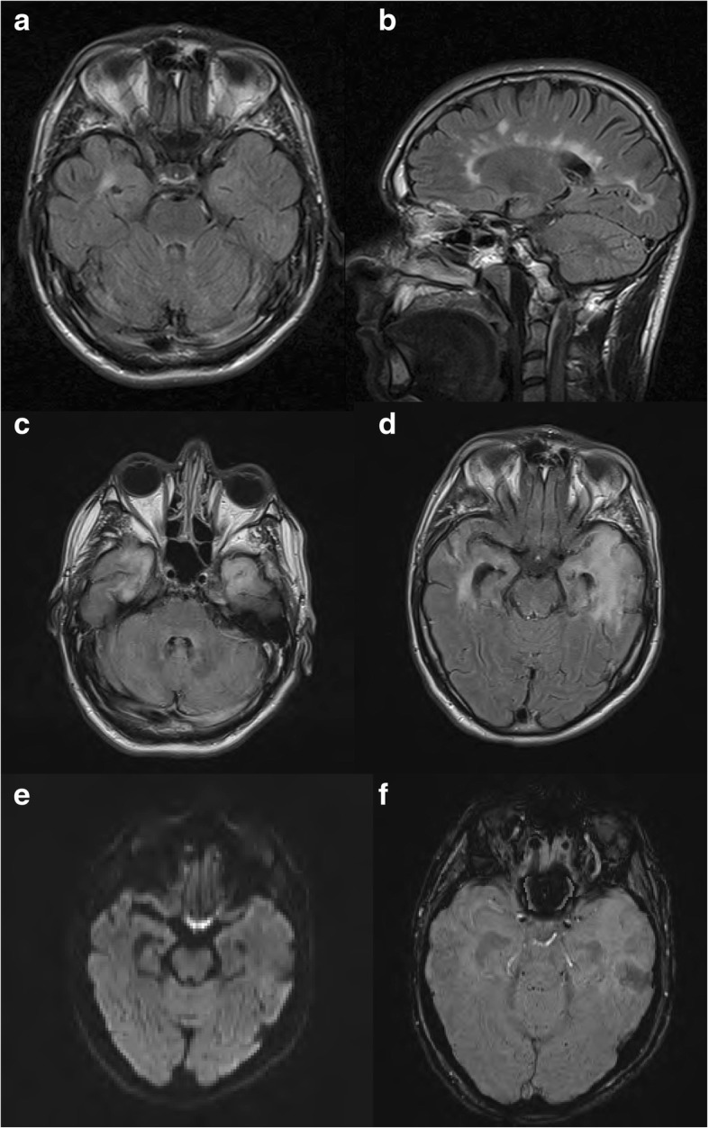 Axial FLAIR (a) and saggital FLAIR (b) sequences from last surveillance MRI for his MS taken 2 months prior to presentation shows stable periventricular white matter lesions with evidence of an isolated demyelinating plaque in his right temporal horn. Axial FLAIR (c and d) sequence at presentation shows high signal abnormality in both temporal lobes extending to the insular cortex. Axial diffusion weighted imaging (e) shows no restricted diffusion and susceptibility weighted imaging (f) shows no area of focal haemorrhage