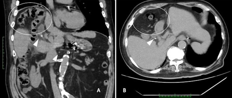 Case 2: Computed tomography (CT).Computed tomography (CT) revealed a gallstone impacted in the cystic duct (A, arrowhead). Additionally, the transverse colon was interposed between the diaphragm and the liver and was in close contact with the gallbladder (A and B, circles).
