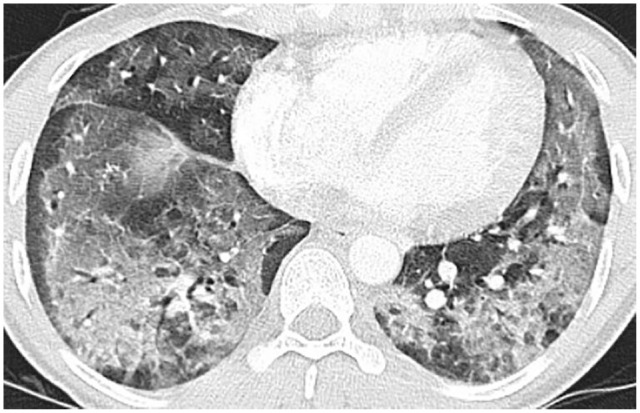 Diffuse bilateral ground glass opacities with crazy paving pattern with subpleural sparing.