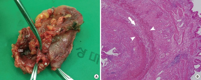 Macroscopic view (A) of the specimen and microscopic features of the duplicated GB (B). The GB body shows separation of the lamina propria and muscle layer (arrowhead). Perimuscular connective tissue (arrow) is shared between the GB 2 bodies with H & E staining (× 40).GB = gallbladder, H & E = hematoxylin and eosin.