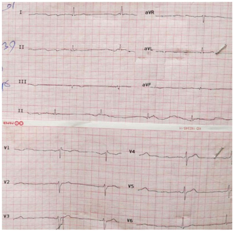 ECG shows sinus bradycardia and no ST-T change