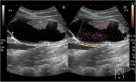 Abdominal ultrasonography showed two tumors extending into the common bile duct. Doppler ultrasound showed a blood flow signal within the tumor
