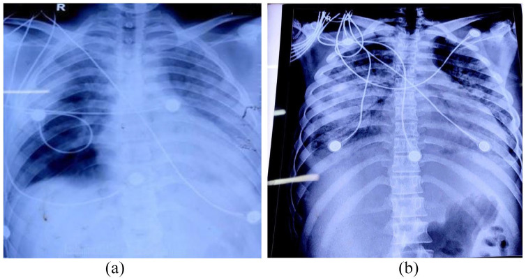 X-ray showing increased opacity in bilateral lung fields predominately involving bilateral middle lungs.