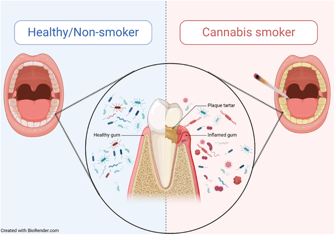 Smoking cannabis can induce oral dysbiosis.
