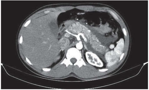 Computed tomography scan of the abdomen showing edematous pancreas with fat stranding and evidence of fluid collection