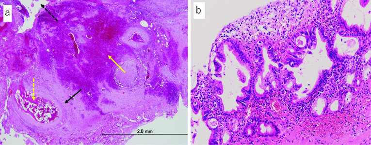 Histological findings following hematoxylin and eosin staining. a Hemorrhage under the bile duct epithelium (dotted black arrow) at a site irrelevant to the CIS. Embolic material (dotted yellow arrow) is observed in the ruptured artery (solid black arrow), which is interpreted as the cause of hemorrhage. Hemorrhage site (solid yellow arrow) is accompanied by vascular proliferation that is considered to have existed before the hemorrhage. b Image of the CIS. No ulcer was observed