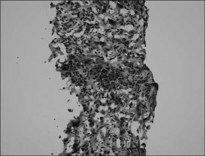 Frozen slide of liver biopsy shows poorly differentiated adenocarcinoma (H&E stain, ×200).