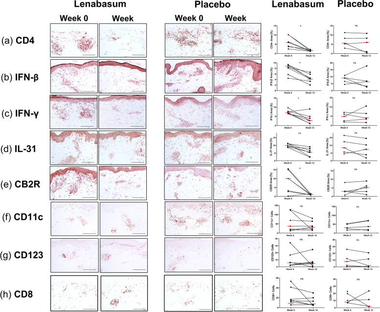 Cytokine and cell expression in DM lesional skin treated with Lenabasum versus placebo. Skin biopsies from lesional DM skin stained via immunohistochemistry for a CD4+ cells, b IFN-β, c IFN-γ, d IL-31, e CB2R, f CD11c+ cells, g CD123+ cells, and h CD8+ cells at week 0 and week 12 following treatment with either lenabasum or placebo. Representative IHC images are pictured at ×20 objective magnification. Quantification of cell counts and percentage of area stained positive are pictured adjacently. Cells were counted in five non-overlapping ×40 fields and averaged. Percentage of area stained positive was quantified in one ×20 field. Epidermis excluded. Graph shows the median. *p<0.05