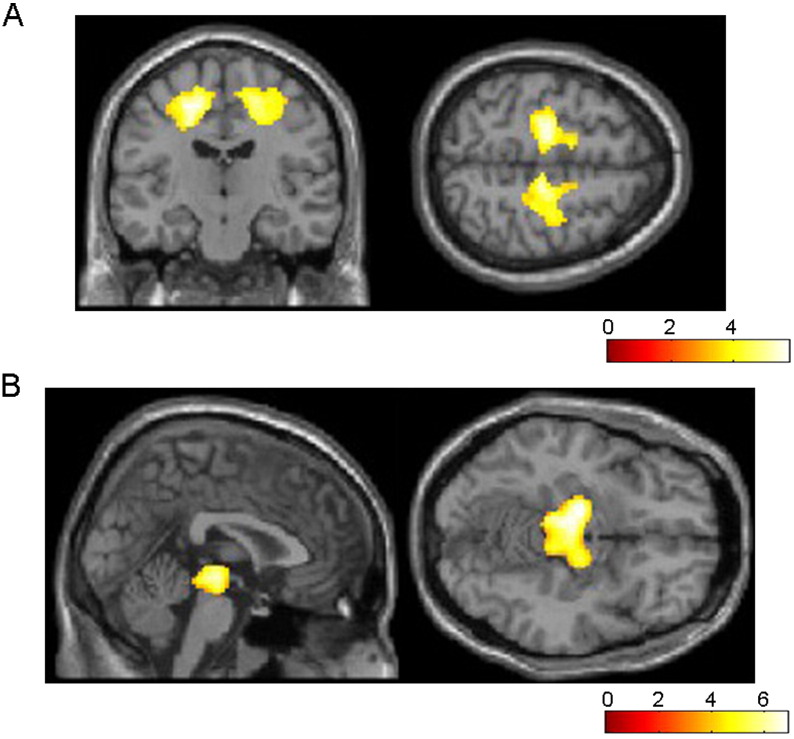 Regions of WM reduction in CBS (A) and RS (B) patients relative to controls. The most significant areas of atrophy observed in 9 CBS patients compared to 16 controls are the bilateral frontal subcortical WM including the left dominant bilateral precentral and right cingulate gyrus (A). The most significant areas of atrophy observed in 17 RS patients compared to 16 controls are in the bilateral midbrain (B). Significance maps of WM reduction in CBS and RS patients are superimposed on a T1-weighted brain MRI template image in the Montreal Neurological Institute space. The color bar represents the t value.