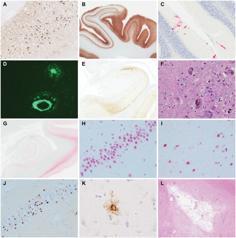 Representative neurodegenerative pathology. (A) Alzheimer disease with neurofibrillary tangles in CA1 (p-tau, AT8). (B) Alzheimer disease with neurofibrillary degeneration in the calcarine cortex (p-tau, AT8). (C) Alzheimer disease with β-amyloid deposition in the cerebellar molecular layer (β-amyloid, 6E10). (D) Neocortical cerebral amyloid angiopathy and a neuritic plaque (Thioflavin S). (E) Primary age-related tauopathy with neurofibrillary tangles primarily affecting CA2 (AT8). (F) Lewy bodies in pigmented substantia nigra neurons (LFB/H&E). (G) Limbic stage Lewy body disease with Lewy bodies and Lewy neurites in the CA2 subregion (α-synuclein). (H) TDP-43 inclusions in the cytoplasm of dentate gyrus neurons. (I) TDP-43 inclusions in the cytoplasm of pyramidal cortical neurons. (J) Pick bodies in dentate gyrus neurons (3R tau). (K) Progressive supranuclear palsy with a cortical tufted astrocyte (4R tau). (L) Remote infarct in the basal ganglia (H&E).