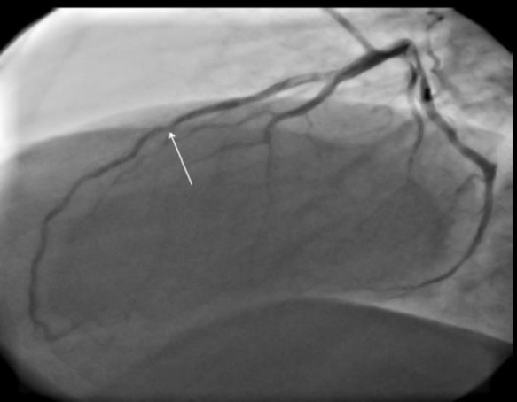 In-stent restenosis in proximal part of previous stent in LAD