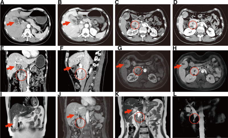 The results of the patient’s CT and MRCP. (A,B) Preoperative CT scans in the arterial (A) and venous phases (B) revealed irregular thickening of the gallbladder wall and the formation of a soft tissue mass protruding into the gallbladder cavity. The cavity was filled with irregular masses, and the boundaries were unclear. (C,D) Preoperative CT scans in the arterial (C) and venous phases (D) revealed a mass at the distal end of the common bile duct, with dilation of the proximal part. (E,F) The coronal (E) and sagittal (F) views in the CT scan indicated a space-occupying lesion within the gallbladder cavity, as well as stenosis of the distal common bile duct and dilation of the proximal common bile duct. (G,H) The MRI arterial (G) and venous phases (H) indicated an enlarged gallbladder volume. Irregular nodular thickening was observed on the base and body wall of the gallbladder, with soft tissue masses protruding into the gallbladder cavity. After enhanced scanning, the masses showed heterogeneous enhancement. (I) The MRI coronal view shows a lesion within the gallbladder. (J–L) The MRI coronal scan (J,K) and MRCP (L) indicate that the distal end of the common bile duct is narrowed, while the proximal part is dilated. The arrow indicates the lesion of the gallbladder. The circular mark indicates the lesion of the common bile duct. CT = computed tomography, MRCP = magnetic resonance cholangiopancreatography, MRI = magnetic resonance imaging.