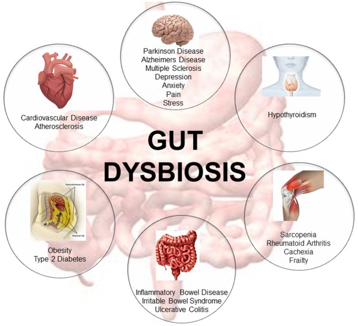 Representative description of the metabolic diseases, gastrointestinal disorders, neuromusculoskeletal conditions, endocrine pathologies, neurodegenerative, and cardiovascular diseases associated with gut dysbiosis [adapted from Buford (10)].