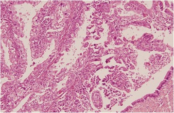 Adenocarcinoma protruding in the lumen