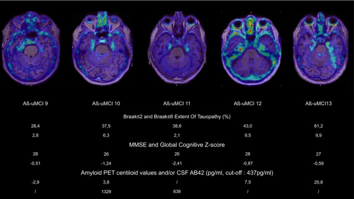 [18F]MK‐6240 PET‐MR fused images of five etiologically undefined mild cognitively impaired amyloid negative subjects (Aβ− uMCI). Aβ− uMCI 13 is suspected of early Alzheimer's disease and the remaining four are suspected of Primary age‐related tauopathy (PART). Quantitative [18F]MK‐6240 PET data, cognitive tests results, Amyloid PET, and CSF results are displayed. Braak ≤ 2: Region corresponding to the mesiotemporal lobe. Braak ≤ 6: Region corresponding to the whole neocortex and some gray nuclei. CSF, cerebrospinal fluid; MMSE, mini‐mental score examination.