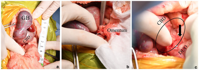 Surgical exploration of the abdomen. (a) Enlarged gallbladder and dilated common bile duct were confirmed. Tape measure in centimetres shown for scale. (b,c) A thickened and hardened common bile duct was observed, with adherence to the omentum and surrounding fat. The black circle indicates the thickened and hardened region of the common bile duct. The black arrow indicates the orifice of the common bile duct. CBD = common bile duct; DUO = duodenum; GB = gallbladder