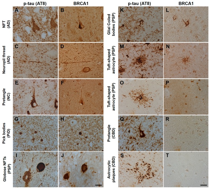 Immunohistochemical studies using antibodies against phosphorylated tau (AT8) and BRCA1 (MS110) in human tauopathy patients’ brains. (A–D) Neurofibrillary tangles (NFTs) and neuropil threads in Alzheimer’s disease (AD) patients’ brains were immunopositive for BRCA1 (E,F). In normal control (NC), BRCA1 positivity was observed in the nucleus in the hippocampus despite AT8 positivity in the cytoplasm. (G,H) Pick bodies in Pick’s disease (PiD) were immunopositive for BRCA1. (I–L) Globose NFT in the midbrain and precentral cortex and glial coiled bodies in the cerebral white matter of progressive supranuclear palsy (PSP) patients’ brains were immunopositive for BRCA1. (M–P) Although some BRCA1 positivity partially resembling tuft-shaped astrocytes was observed in the frontal cortex (M,N), cytoplasmic BRCA1 positivity was not observed close to most of the AT8-positive tuft-shaped astrocytes in PSP patients (O,P). (Q–T) In corticobasal degeneration (CBD) patients’ brains, no cytoplasmic BRCA1 staining was observed close to pretangles or astrocytic plaques. p-tau, phosphorylated tau. The scale bars represent 20 µm.