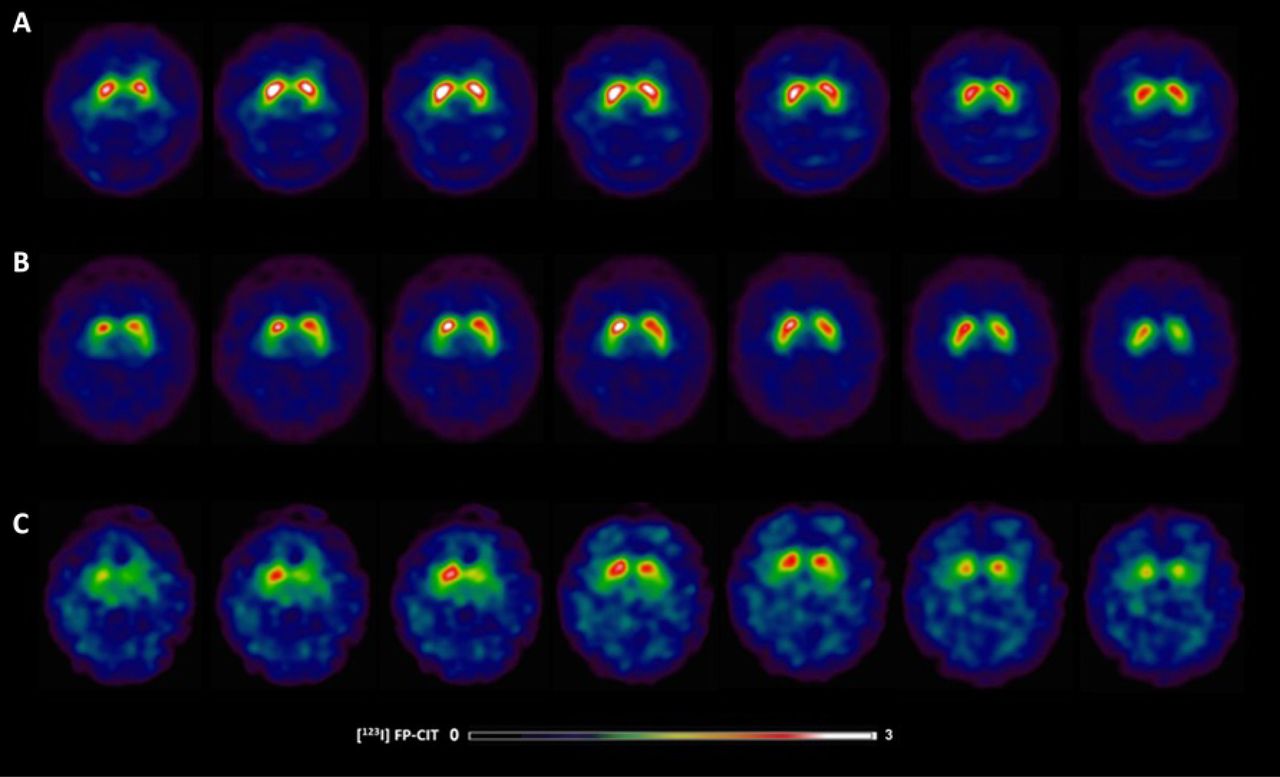 [123I]FP-CIT SPECT images in Parkinson’s disease patients with and without swallowing and chewing difficulties.(A) 63-year-old healthy control showing typical [123I]FP-CIT specific binding ratios in the caudate (SBR: 3.87) and putamen (SBR: 2.65) (B) 63-year-old male without swallowing difficulties exhibiting slight dopaminergic deficits as reflected by [123I]FP-CIT specific binding ratios in the caudate (SBR: 2.92) and putamen (SBR: 2.15); (C) 63-year-old female with swallowing difficulties demonstrating larger striatal dopaminergic deficits as reflected by [123I]FP-CIT specific binding ratios in the caudate (SBR: 1.00) and putamen (SBR: 0.58).