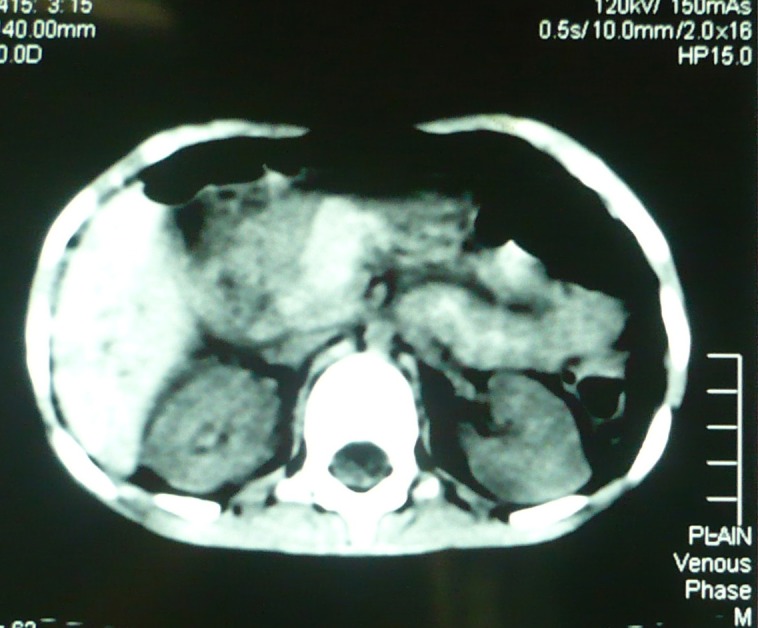 Figure 1: CT scan of abdomen showing pancreatic contusion injury; the pancreas is swollen and duodenal area is obscured by hypodense area.