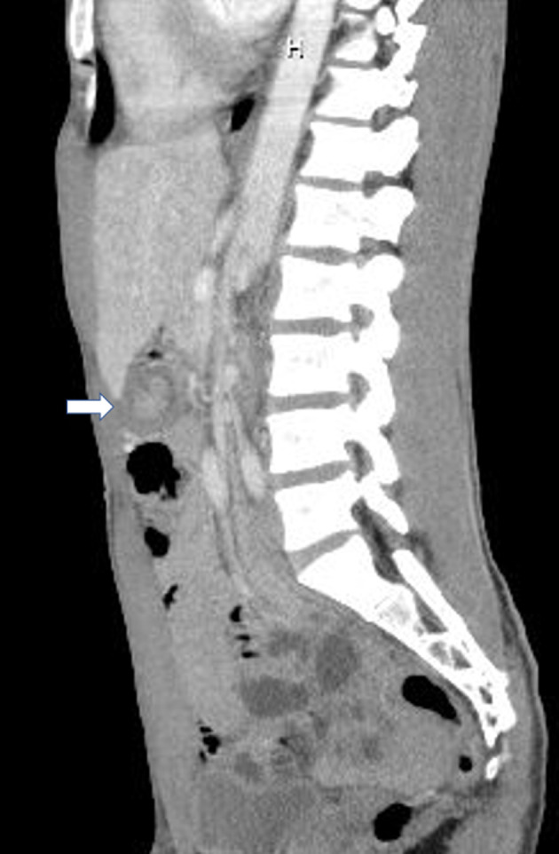 Computed tomography (CT) scan (sagittal with arrow) showing telescoping of small bowel within itself consistent with small bowel intussusception with no evidence of inflammation in the colon or appendix.