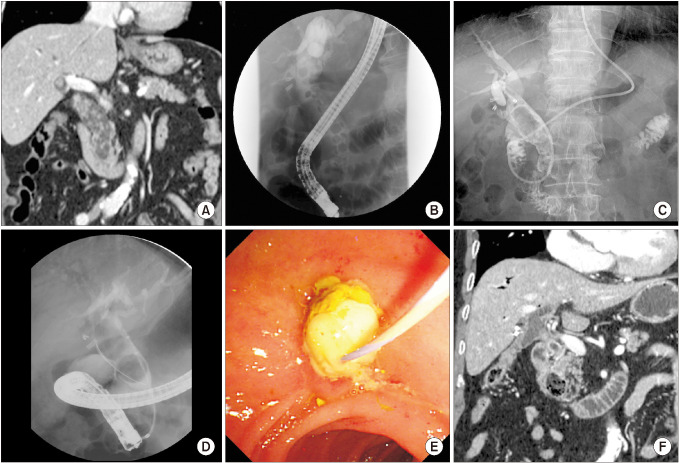 (A) CT findings at the first visit. Heterogeneous material fills in the dilated common bile duct (CBD). (B) Cholangiography findings by endoscopic retrograde cholangiopancreatography at the first visit. Numerous and various sized round filling defects in the dilated CBD. (C) Findings from a cholangiography performed through a nasobiliary drainage tube at the third recurrence. Unlike the first attack, larger filling defects are impacted within the dilated CBD. (D) Cholangiography findings at the first recurrence of CBD stones after choledochoduodenostomy (CDS). As with previous recurrence findings, large filling defects are impacted within the dilated CBD. (E) Endoscopic findings at the third recurrence of CBD stones after CDS. Whitish pus is drained from the CDS site. (F) The last CT findings at 48 months after choledochojejunostomy (CJS). Stone recurrence is not observed in the remaining proximal CBD and CJS areas.