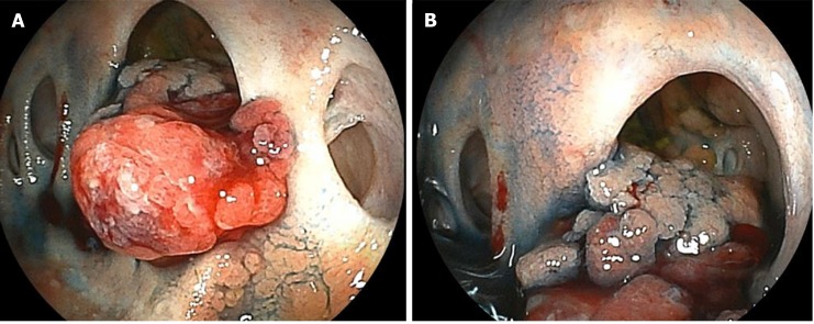 Double balloon enteroscopy shows the cholangiojejunostomy directly. A: There are four-hole anastomoses: Anterior hole, posterior hole, B2 plus B3 hole, and B4 hole, from right to left. A reddish and hemorrhagic tumor protrudes from the posterior hole; B: The tumor extends inside the posterior branch.