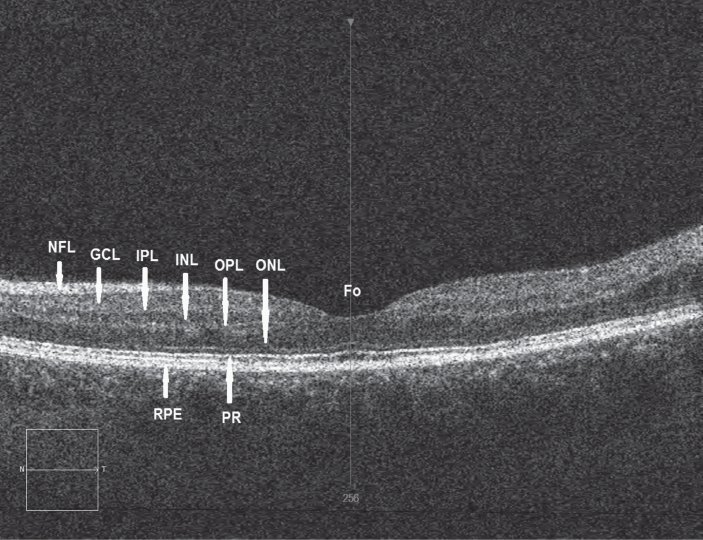 Retinal image of a normal control subject using optical coherence tomography (OCT) showing the various functional layers: Fo = Location of fovea, NFL = Nerve fibre layer, GCL = Ganglion cell layer, IPL = Inner plexiform layer, INL = Inner nuclear layer, OPL = Outer plexiform layer, ONL = Outer nuclear layer, RPE = Retinal pigment epithelium, PR = Photoreceptor layer, N = Nasal direction, T = Temporal direction. A specific thinning of INL in the parafoveal region has been recorded in Parkinson’s disease (PD). (Image courtesy Dr R Heitmar, Aston University)