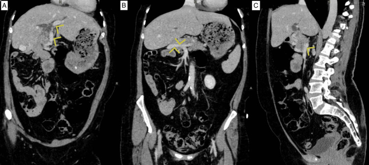 Computed tomography coronal and sagittal views showing the portal vein (yellow arrows) coursing anterior to the pancreas up to the porta hepatis (A), the second portal vein (yellow arrows) joined by the splenic vein posterior to the pancreas (B, C).