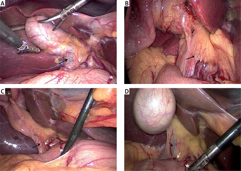 The white arrows show different type of supraduodenal pedicle. The CBD (black arrows) locate at the right and dorsal region of the rightmost branch of supraduodenal pedicle. Five-pointed star shows prepyloric vein
