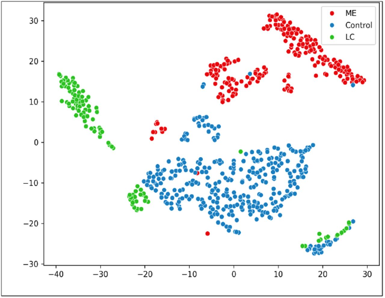 t-SNE showing partial separation among ME/CFS, Long COVID, and healthy controls.