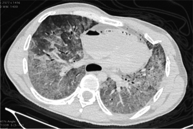 CT image showing massive edema of the lungs