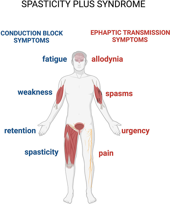 The spasticity-plus syndrome (SPS) model characteristics. The new spasticity-plus syndrome, differently from the classical model, supports the hypothesis that spasticity, triggered by central nervous system (CNS) damage, and other symptoms caused by axon demyelination in terms of conduction block (spasticity, fatigue, weakness, and retention) and ephaptic transmission (spasms, pain, allodynia, and urgency) (see further in the text) are placed on the same level. This model implies that spasticity could be even milder compared to the other associated symptoms.