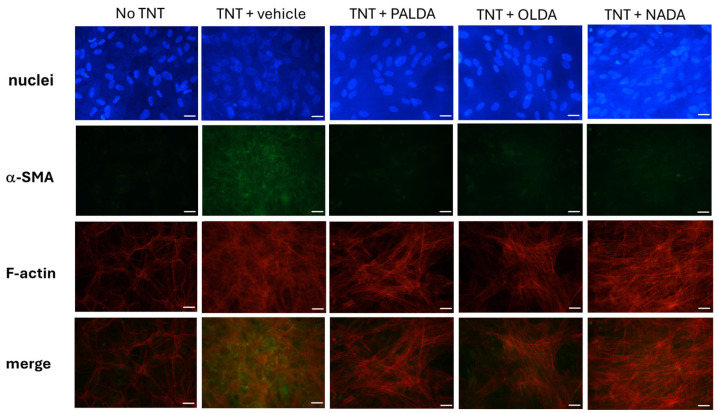 The effects of N-acyl dopamines on α-SMA expression in F-actin stress fibers of transdifferentiated human RPE cells. Representative images of immunostaining of F-actin stress fibers (red), α-SMA (green), and their co-expression (orange/yellow in the merged images) are shown. Primary cultured human RPE cells were plated on collagen gels and treated with the vehicle or OLDA, PALDA, or NADA, plus TNT (10 ng/mL) for 72 h. The collagen gels were fixed on the slide and immunostained for F-actin stress fibers with CF583R, labeled phalloidin, and α-SMA with an Alexa Fluor 488, labeled anti-α-SMA, antibodies. The photos were taken using 40× objectives and the scale bars represent 25 micrometers.