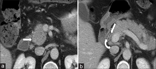 A 48-year-old woman with right upper abdominal quadrant pain. The images are of an IV contrast-enhanced transverse MDCT with no positive intraduodenal contrast filling. (a) One observer falsely described a distal CBD rim-like calcified stone (straight arrow). (b) Cranial images following the proximal CBD showed that this false-positive result was due to volume averaging of the enhancing mucosa at the confluence of a low inserting cystic duct (curved arrow) with the distal CBD (straight arrow)