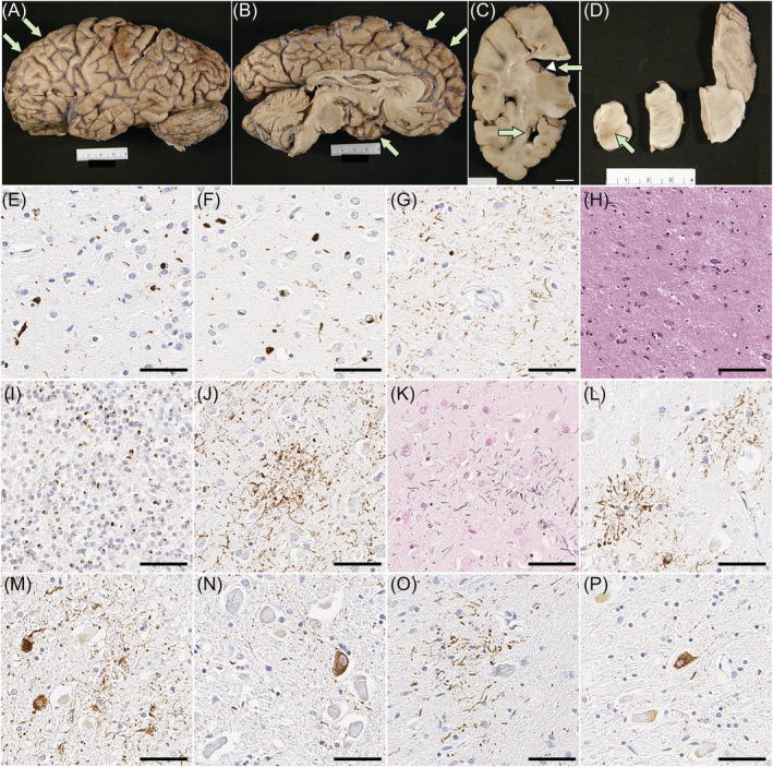 Pathologic findings of case 1. (A–D) Macroscopic finding reveals minimal cortical atrophy in the frontal and temporal lobes (arrows in A and B), thinning of the corpus callosum (arrowhead in C) and marked enlargement of the frontal horn of the lateral ventricle (arrows in C). The substantia nigra shows loss of pigment (arrow in D). Immunohistochemistry for pTDP‐43 (E–G), C9RANT (I) and CP13 (J, L–P), as well as H&E (H) and Gallyas staining (K). There are neuronal cytoplasmic inclusions, dystrophic neurites and neuronal intranuclear inclusions in the midfrontal cortex (E) and inferior temporal cortex (F), consistent with FTLD‐TDP type A. (G) CA1 sector of the hippocampus has neuronal cytoplasmic inclusions and numerous fine neurites, accompanied by neuronal loss (H), consistent with hippocampal sclerosis. (I) Numerous inclusions are C9rant‐positive in the cerebellar granular layer. Astrocytic plaques are present in the motor cortex (J, K) and superior frontal cortex (L). A mild degree of pretangles and threads are present in the subthalamic nucleus (M), pontine base (N), inferior olivary nucleus (O) and cerebellar dentate nucleus (P). Scale bars: 1 cm in C, 50 μm in E‐P