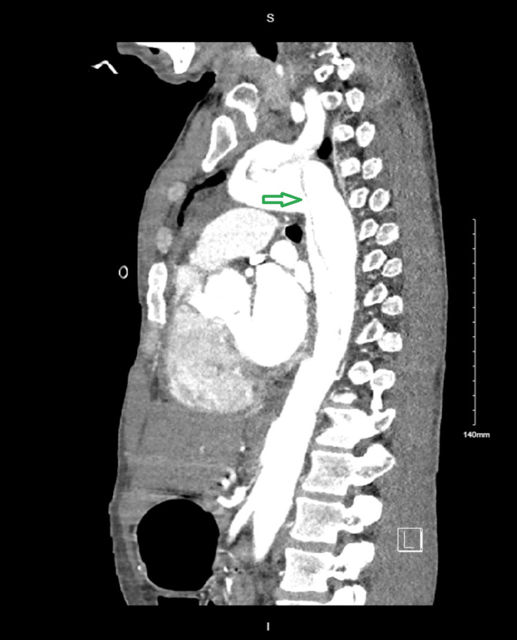 CTA of the chest - sagittal planeGreen arrow: acute type A aortic dissection involving the descending aortaCTA: computed tomography angiography
