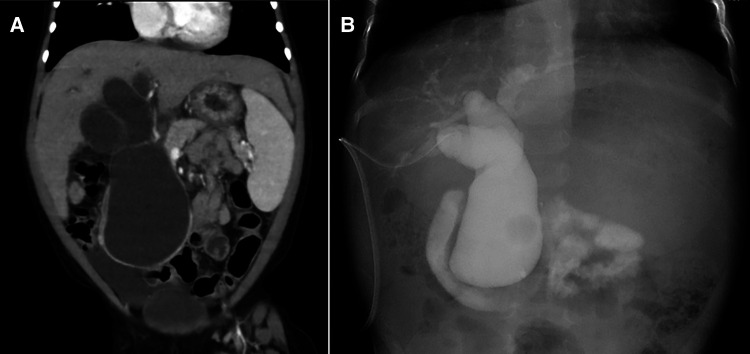 Diagnostic imaging findings (A) contrast-enhanced computed tomography (B) cholangiography.