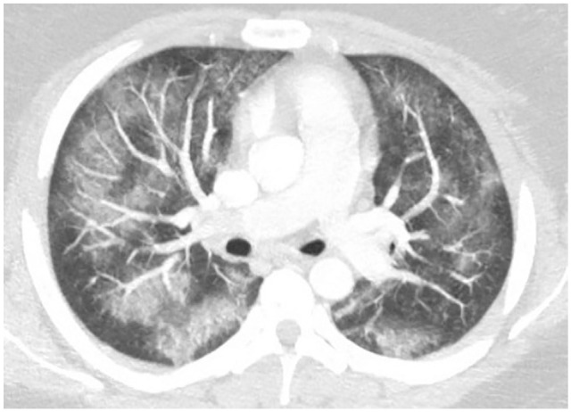 Bilateral patchy ground glass opacities in bronchovascular distribution.