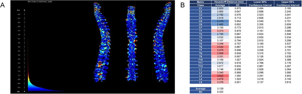 Hausdorff distance between prediction and ground truth by the open-source vertebrae segmentation model of MONAI-Label.(A) Example of the Hausdorff distance calculation between the spineCT-ResSegNet model (native to MONAI-Label) predictions and ground truth. (B) The pre-trained model present in MONAI-Label, trained on the VERSE dataset averages a Hausdorff Distance of 3.129±0.322 mm between model segmentation prediction and ground truth.