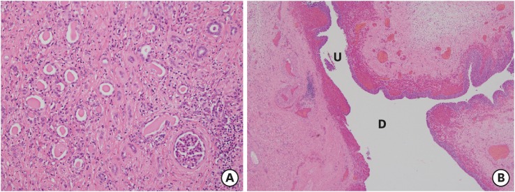 Microscopic finding. (A) Chronic pyelonephritis in renal parenchyma (hematoxylin and eosin, × 200) and (B) the ureter ‘U’ entering directly to the diverticulum ‘D’.