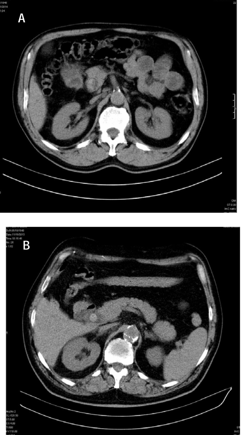 CT unenhanced: hyper attenuation calculi with dilated CBD (a) Terminal CBD; (b) prepancreatic CBD