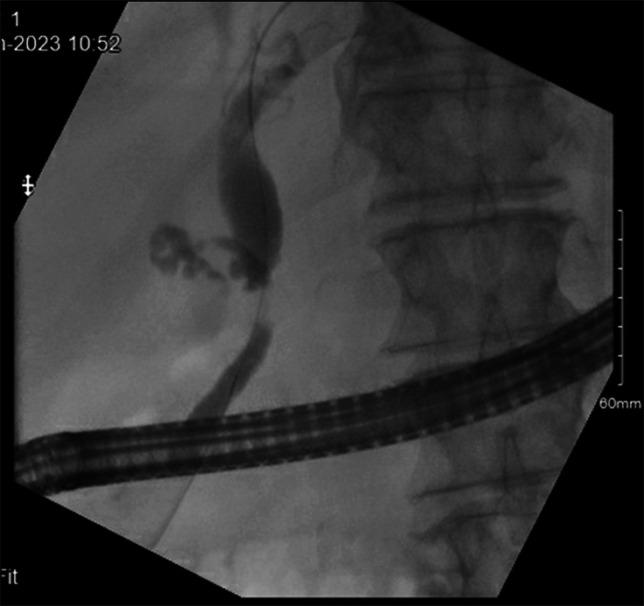 ERCP image demonstrating moderate-to-severe stenosis/stricture extending approximately 1.5 cm in the mid CBD located in the proximity of the cystic duct takeoff. CBD, common bile duct; ERCP, endoscopic retrograde cholangiopancreatography.
