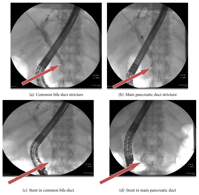 ERCP arrows showing CBD and MPD strictures pre stent insertion (a) and (b); post stent insertion (c) and (d) (clockwise).