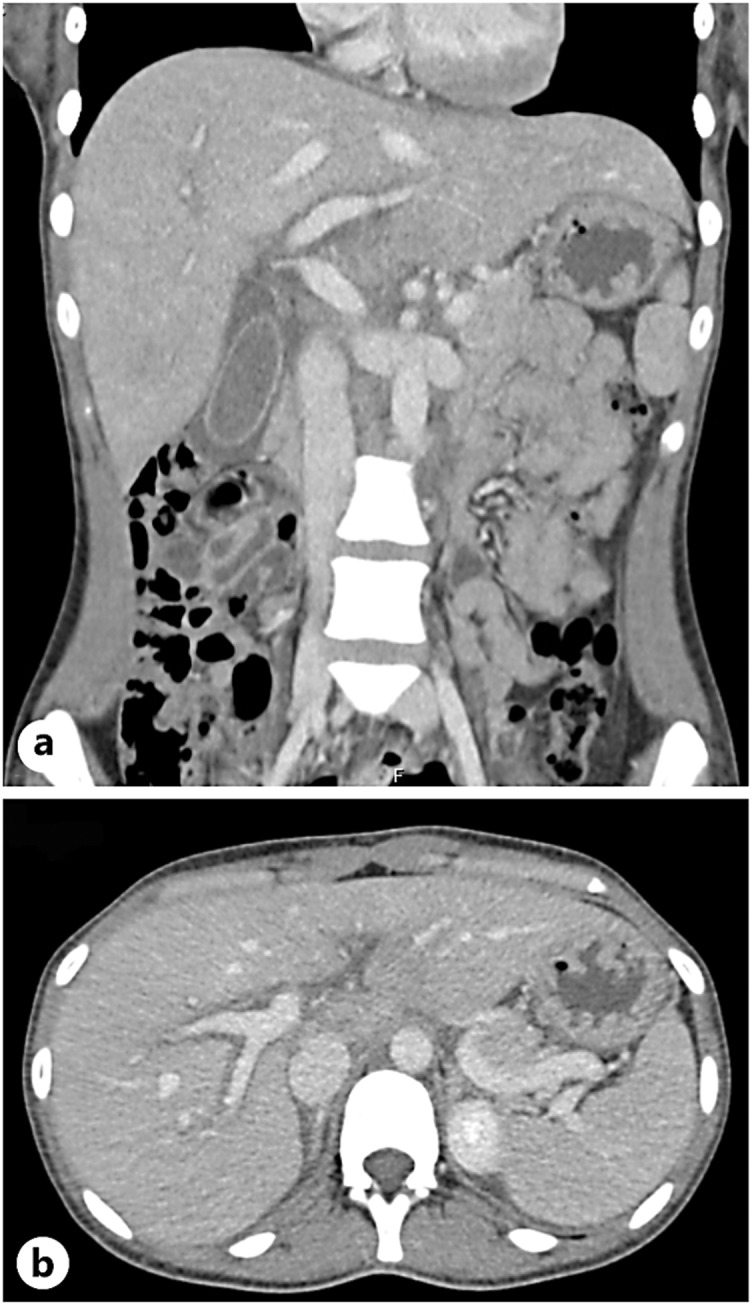 Abdominal CT with IV contrast injection showing a globular liver, with dimensions at the ULN, along with a marked and diffuse reduction in parenchymal density, as well as discrete and diffuse heterogeneous enhancement with signs of periportal edema and marked edematous thickening of vesicular wall. a Coronal view. b Axial view.