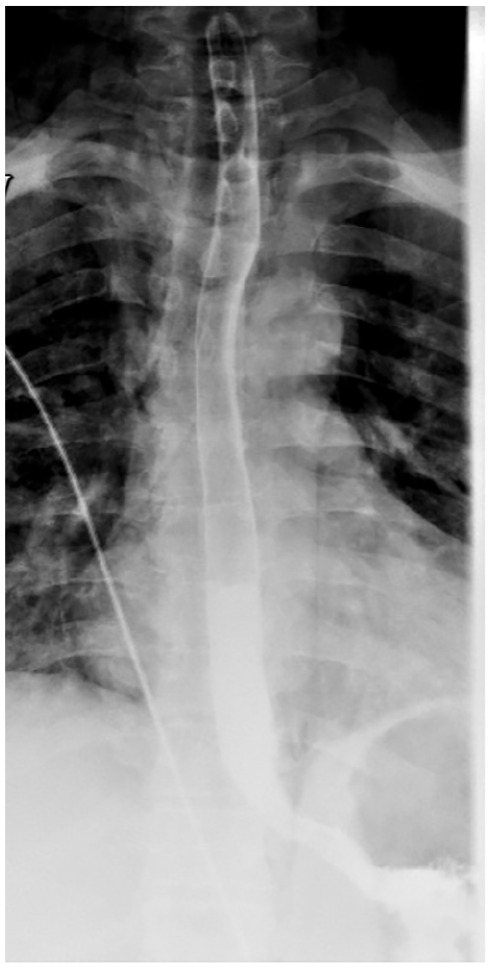 An X-ray image of a chest showing a barium swallow study with no evidence of contrast leaking from the gastrointestinal tract into adjacent areas.