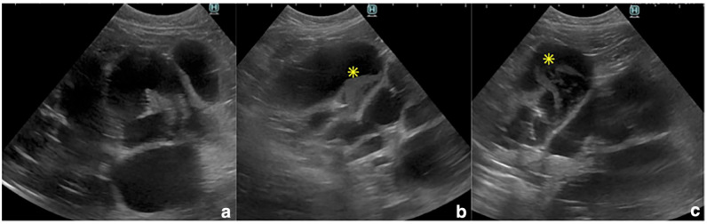 Ultrasonographic image of the liver and dilated common bile duct. (a) Marked saccular dilatation of intrahepatic and extrahepatic biliary tree was confirmed. Thickening and high echogenicity of parts of the gallbladder wall and bile duct wall were observed. (b,c) There is a collection of organised, dependent echogenic debris within the common bile duct dilatation (asterisks)