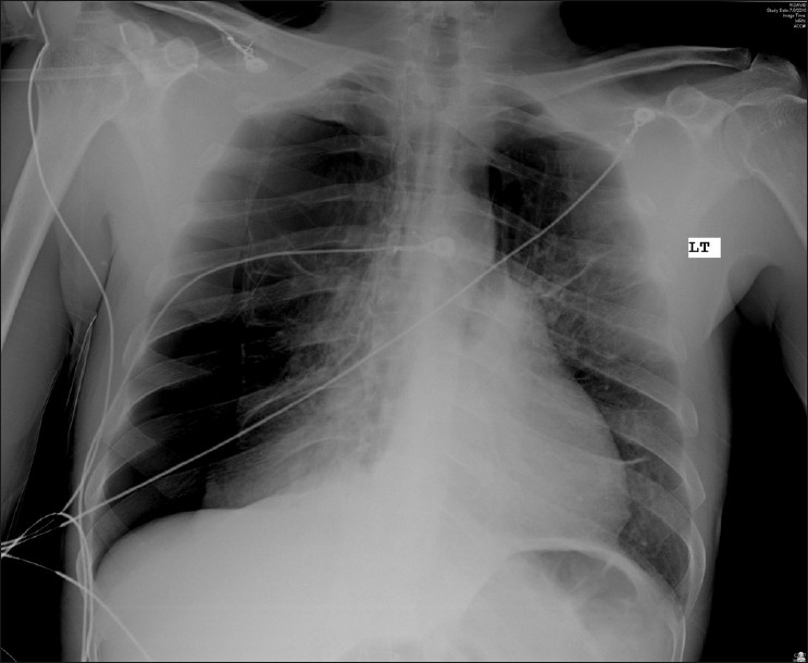 Chest radiograph showing right-sided pneumothorax on presentation