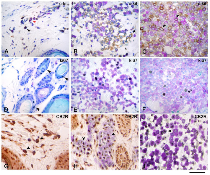 Immunohistochemistry of c-kit, Ki67, and CB2 receptor with toluidine blue as the counterstain of atopic dermatitis (AD), cutaneous mastocytosis, and cutaneous mast cell tumors (MCTs). Immunohistochemistry of c-kit of AD (A), mastocytosis (B), and MCTs (C) showed cytoplasmic (black arrow) and membranous (red arrow) (A,B) and only membranous (black arrow) (C) c-kit expression of mast cells (MCs). Immunohistochemistry of Ki67 of mastocytosis (E) and MCTs (F) showed nuclear expression of MCs (E,F) visualized by toluidine blue (TB) stain, and MCs in AD were not in cycle; therefore, Ki67 stain was found only on the epithelial cells of hair follicles (black arrows) (D). Mast cells of mastocytosis (H) and MCTs (I) revealed nuclear expression of CB2 receptor (black arrows); by contrast, the MCs of AD (G) showed cytoplasmic expression of the CB2 receptor (black arrow) that hid the metachromatic reaction of TB stain. Scale bar = 50 µm.
