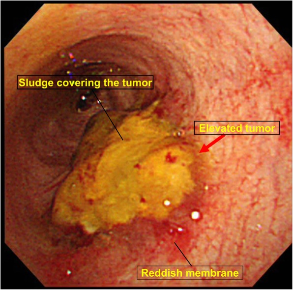 The findings of cholangioscope. It detected an elevated tumor covered by sludge in the common bile duct. The mucous membrane around the tumor showed redness and a malignant tumor was suspected