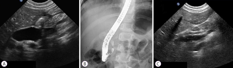 Marked dilated intrahepatic and extrahepatic duct (1.63 cm in diameter) is shown on abdominal ultrasonography, when the patient was re-admitted (A). Endoscopic retrograde cholangiography shows a tight stricture and filling defects in the common bile duct (B). After recanalization, the dilated extrahepatic duct is improved to 0.67 cm in diameter (C).
